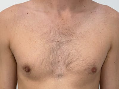 Gynecomastia Before & After Gallery - Patient 148037 - Image 2