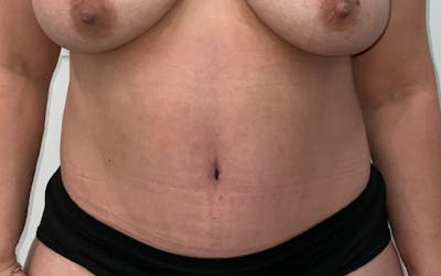 Tummy Tuck Before & After Gallery - Patient 196016 - Image 2