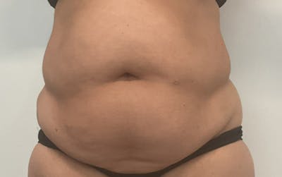 Tummy Tuck Before & After Gallery - Patient 196016 - Image 1