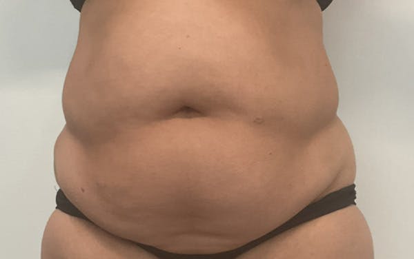 Tummy Tuck Before & After Gallery - Patient 196016 - Image 1