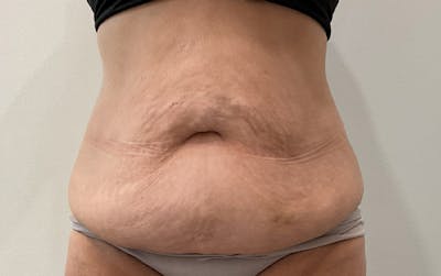 Tummy Tuck Before & After Gallery - Patient 555420 - Image 1
