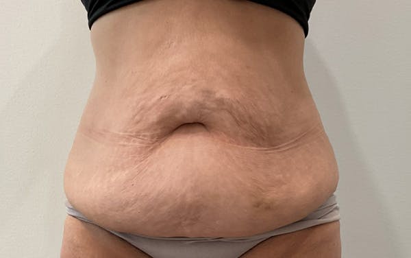 Tummy Tuck Before & After Gallery - Patient 555420 - Image 1