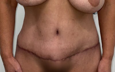 Tummy Tuck Before & After Gallery - Patient 555420 - Image 2