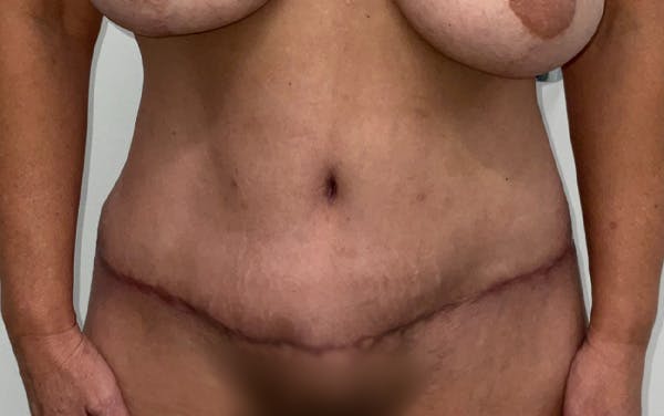 Tummy Tuck Before & After Gallery - Patient 555420 - Image 2