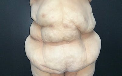 Tummy Tuck Before & After Gallery - Patient 667531 - Image 1