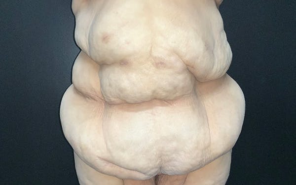 Tummy Tuck Before & After Gallery - Patient 667531 - Image 1