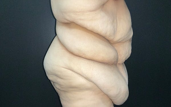 Tummy Tuck Before & After Gallery - Patient 667531 - Image 3