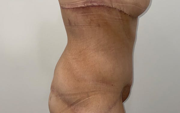 Tummy Tuck Before & After Gallery - Patient 667531 - Image 4