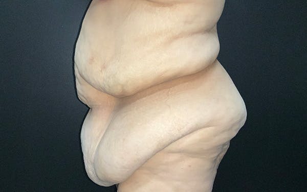 Tummy Tuck Before & After Gallery - Patient 667531 - Image 5