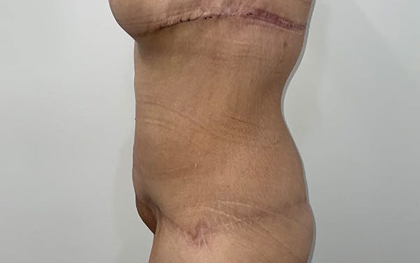 Tummy Tuck Before & After Gallery - Patient 667531 - Image 6