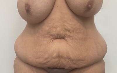 Tummy Tuck Before & After Gallery - Patient 256793 - Image 1