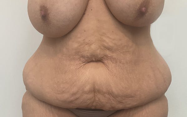 Tummy Tuck Before & After Gallery - Patient 256793 - Image 1