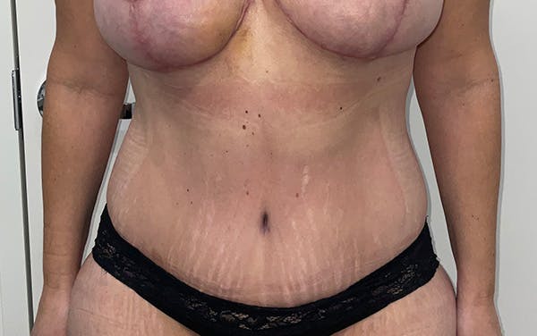 Tummy Tuck Before & After Gallery - Patient 256793 - Image 2