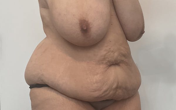 Tummy Tuck Before & After Gallery - Patient 256793 - Image 3