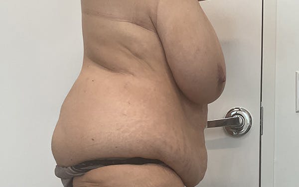 Tummy Tuck Before & After Gallery - Patient 256793 - Image 5