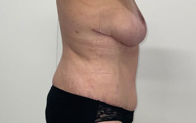 Tummy Tuck Before & After Gallery - Patient 256793 - Image 6