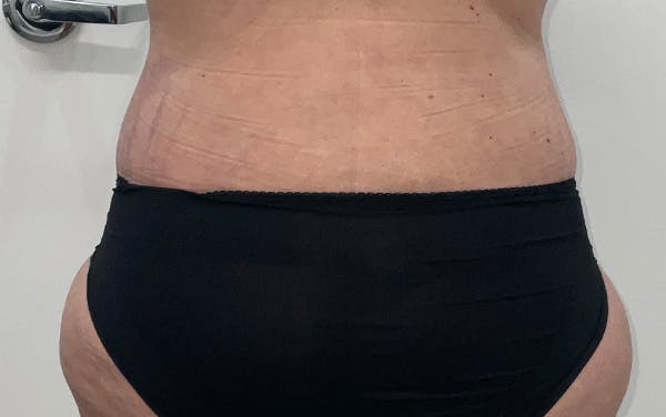 Tummy Tuck Before & After Gallery - Patient 256793 - Image 14