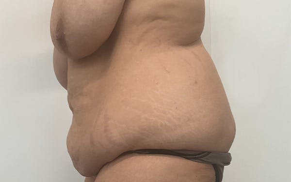 Tummy Tuck Before & After Gallery - Patient 256793 - Image 9