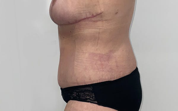 Tummy Tuck Before & After Gallery - Patient 256793 - Image 10