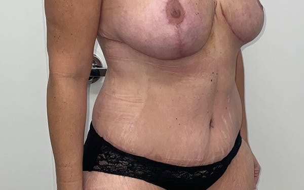 Tummy Tuck Before & After Gallery - Patient 256793 - Image 4