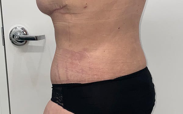 Tummy Tuck Before & After Gallery - Patient 256793 - Image 12