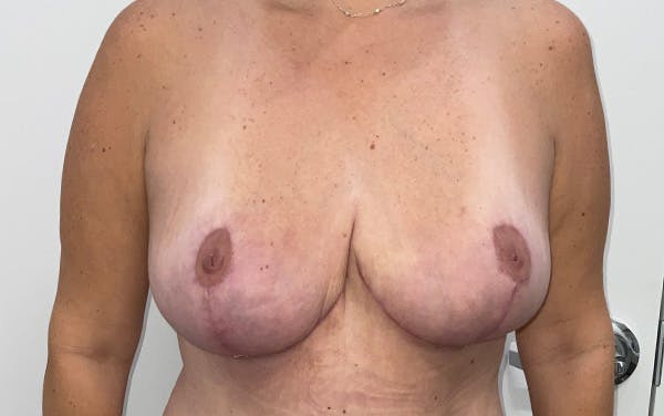 Breast Lift Before & After Gallery - Patient 330427 - Image 2