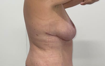 Breast Lift Before & After Gallery - Patient 330427 - Image 6