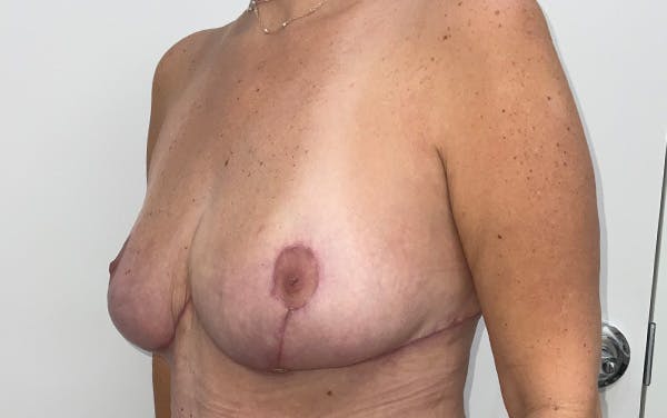 Breast Lift Before & After Gallery - Patient 330427 - Image 8