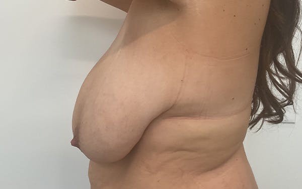 Breast Lift Before & After Gallery - Patient 330427 - Image 9