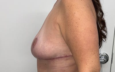 Breast Lift Before & After Gallery - Patient 330427 - Image 10