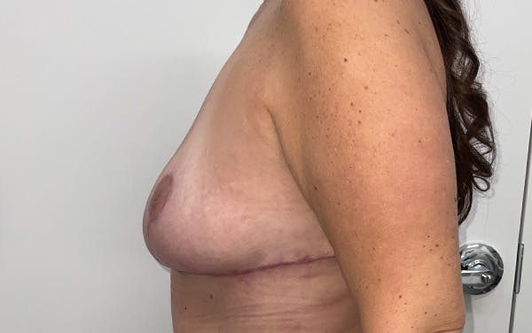 Breast Lift Before & After Gallery - Patient 330427 - Image 10