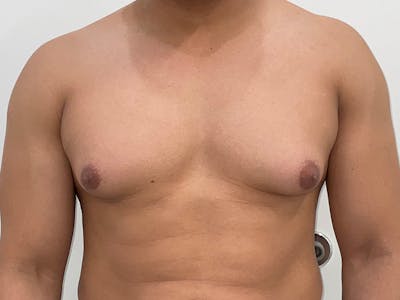 Gynecomastia Before & After Gallery - Patient 176417 - Image 1