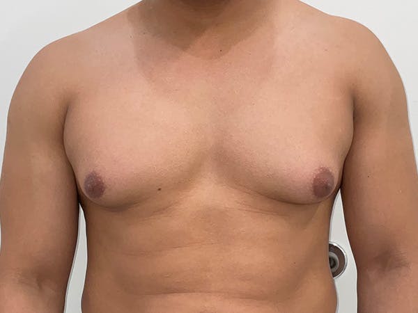Gynecomastia Before & After Gallery - Patient 176417 - Image 1