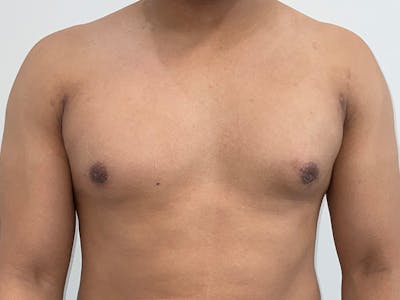 Gynecomastia Before & After Gallery - Patient 176417 - Image 2