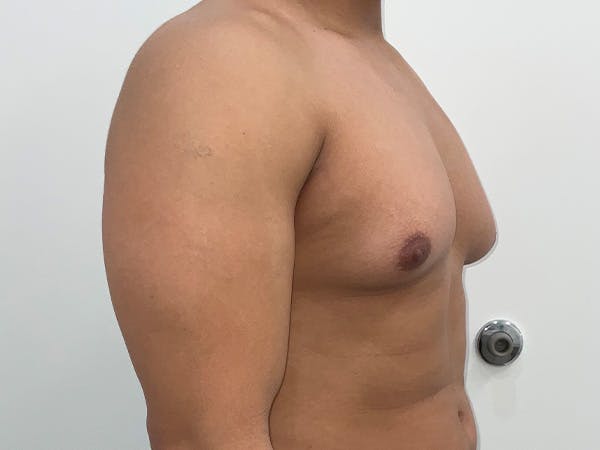 Gynecomastia Before & After Gallery - Patient 176417 - Image 3