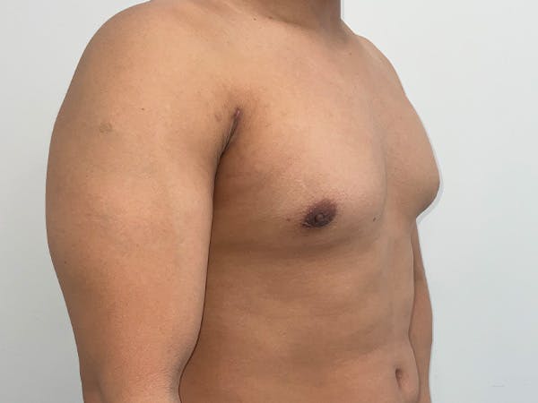 Gynecomastia Before & After Gallery - Patient 176417 - Image 4