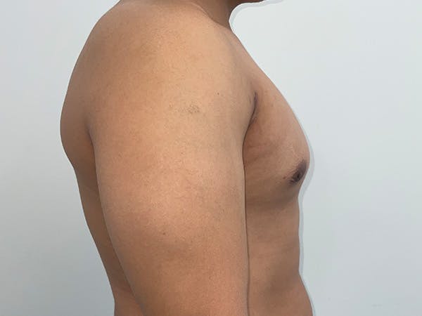 Gynecomastia Before & After Gallery - Patient 176417 - Image 6