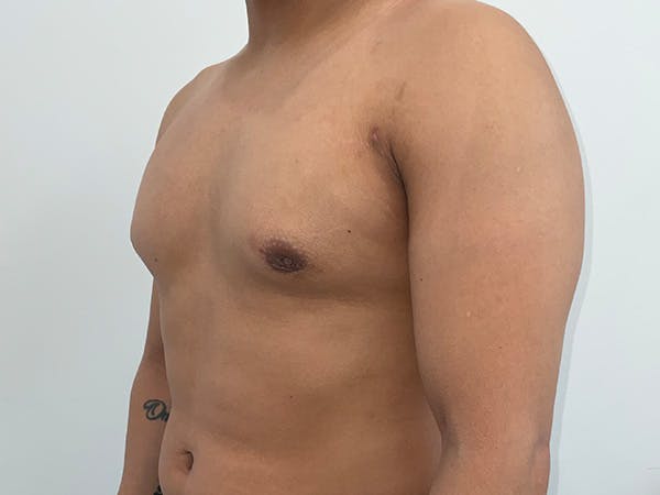 Gynecomastia Before & After Gallery - Patient 176417 - Image 8
