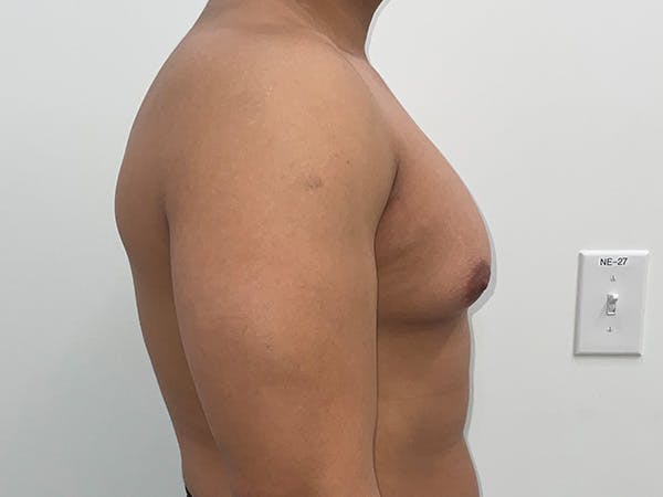 Gynecomastia Before & After Gallery - Patient 176417 - Image 5