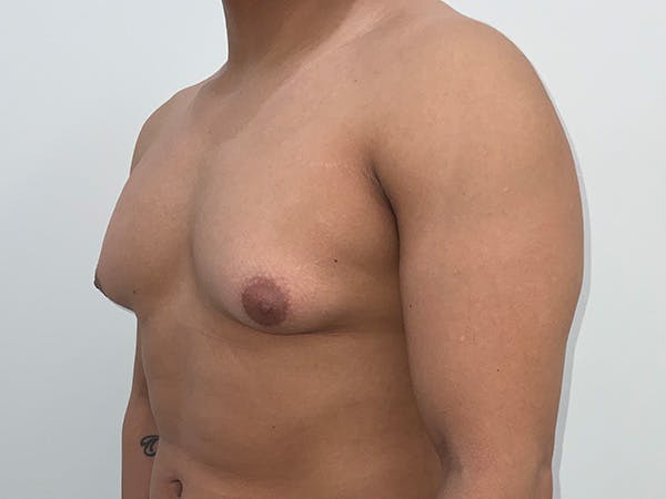 Gynecomastia Before & After Gallery - Patient 176417 - Image 7