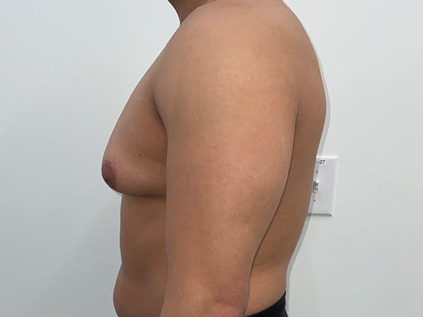 Gynecomastia Before & After Gallery - Patient 176417 - Image 9