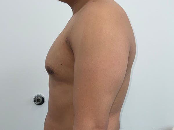 Gynecomastia Before & After Gallery - Patient 176417 - Image 10