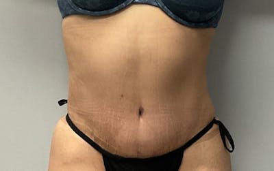 Tummy Tuck Before & After Gallery - Patient 246548 - Image 2
