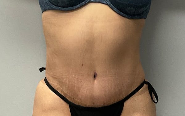 Tummy Tuck Before & After Gallery - Patient 246548 - Image 2