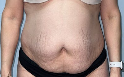 Tummy Tuck Before & After Gallery - Patient 246548 - Image 1