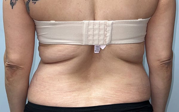 Tummy Tuck Before & After Gallery - Patient 246548 - Image 3