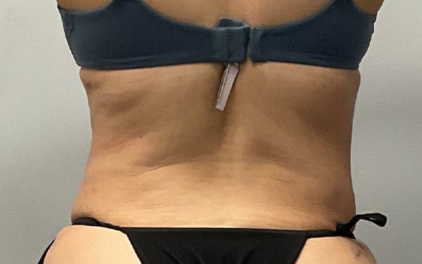 Tummy Tuck Before & After Gallery - Patient 246548 - Image 4