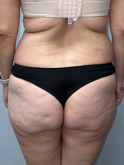 Butt Lift Before & After Gallery - Patient 182673 - Image 1