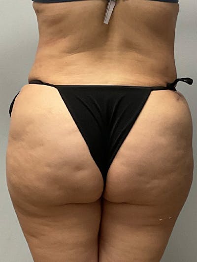 Butt Lift Before & After Gallery - Patient 182673 - Image 2
