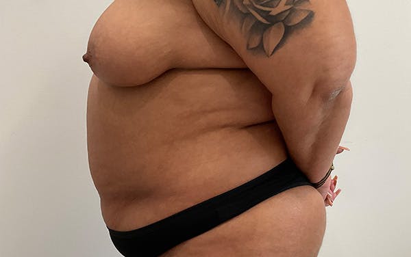 Tummy Tuck Before & After Gallery - Patient 253676 - Image 9